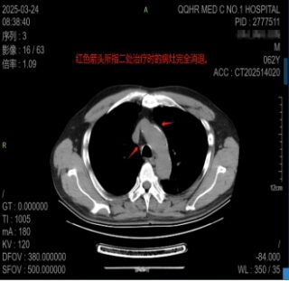 CT image data after value