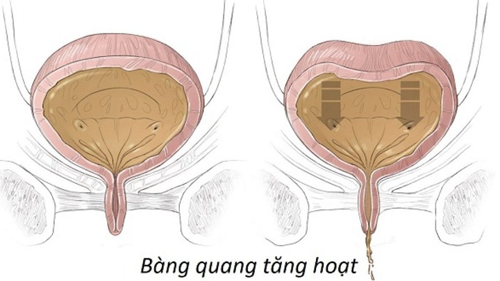 Mẹo nhỏ từ chuyên gia để theo dõi sức khỏe Bàng Quang chủ động